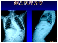 警惕青少年脊柱侧凸+(2002年6月24日)