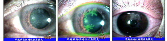黑眼珠亮起来--单疱病毒性角膜炎的治疗
